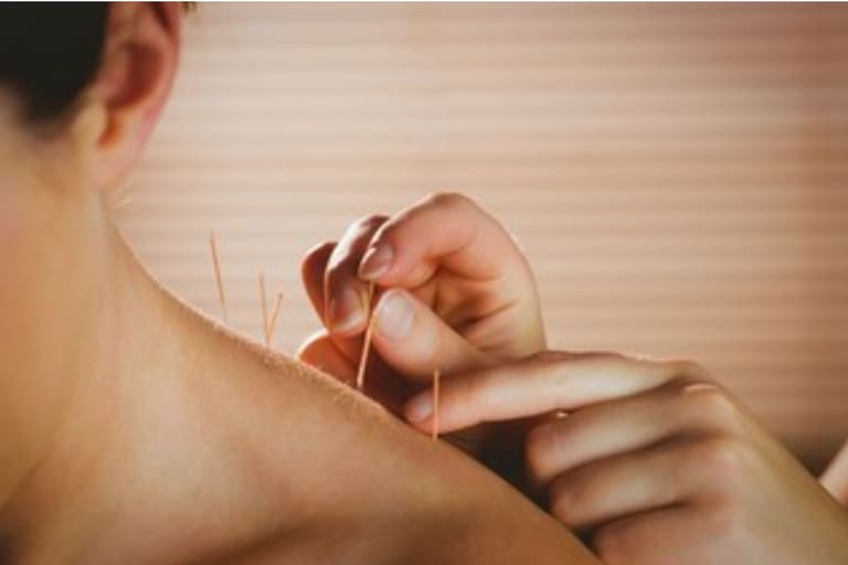 Acupuntura: O que é e para que serve?